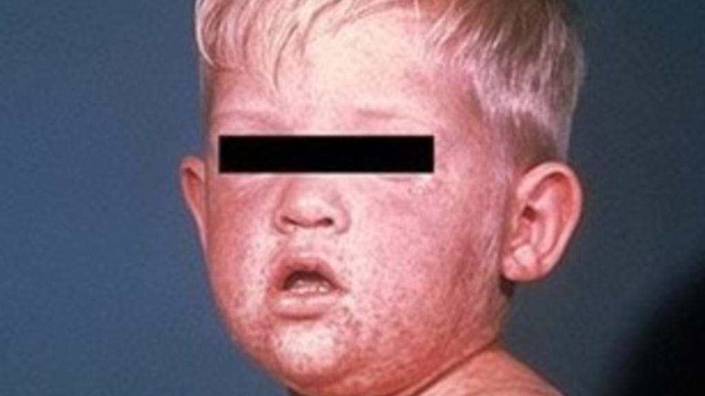 Urgent warning after measles case travelled through Melbourne Airport [Video]